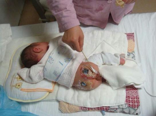 痛心!出生仅一天婴儿 第一澡被无证护士烫伤P