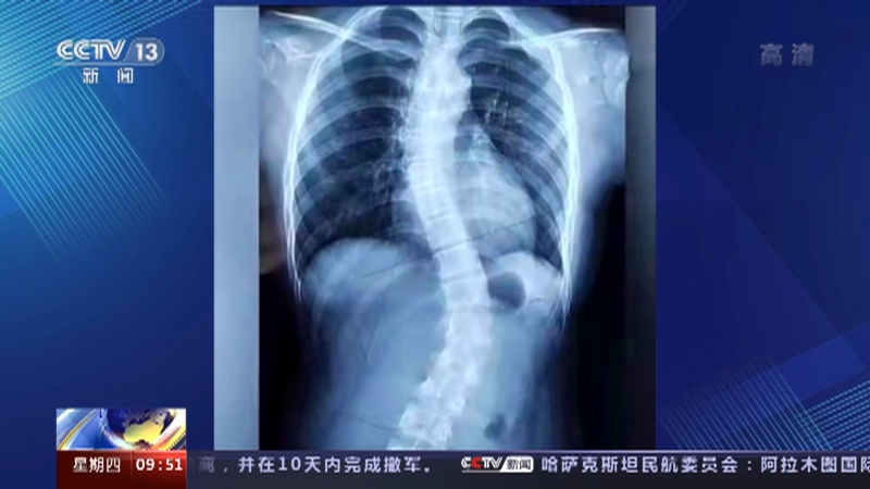 [新闻直播间]河北衡水 不良坐姿致13岁女孩严重脊柱侧弯被送医_CCTV节目官网-CCTV-13_央视网(cctv.com)