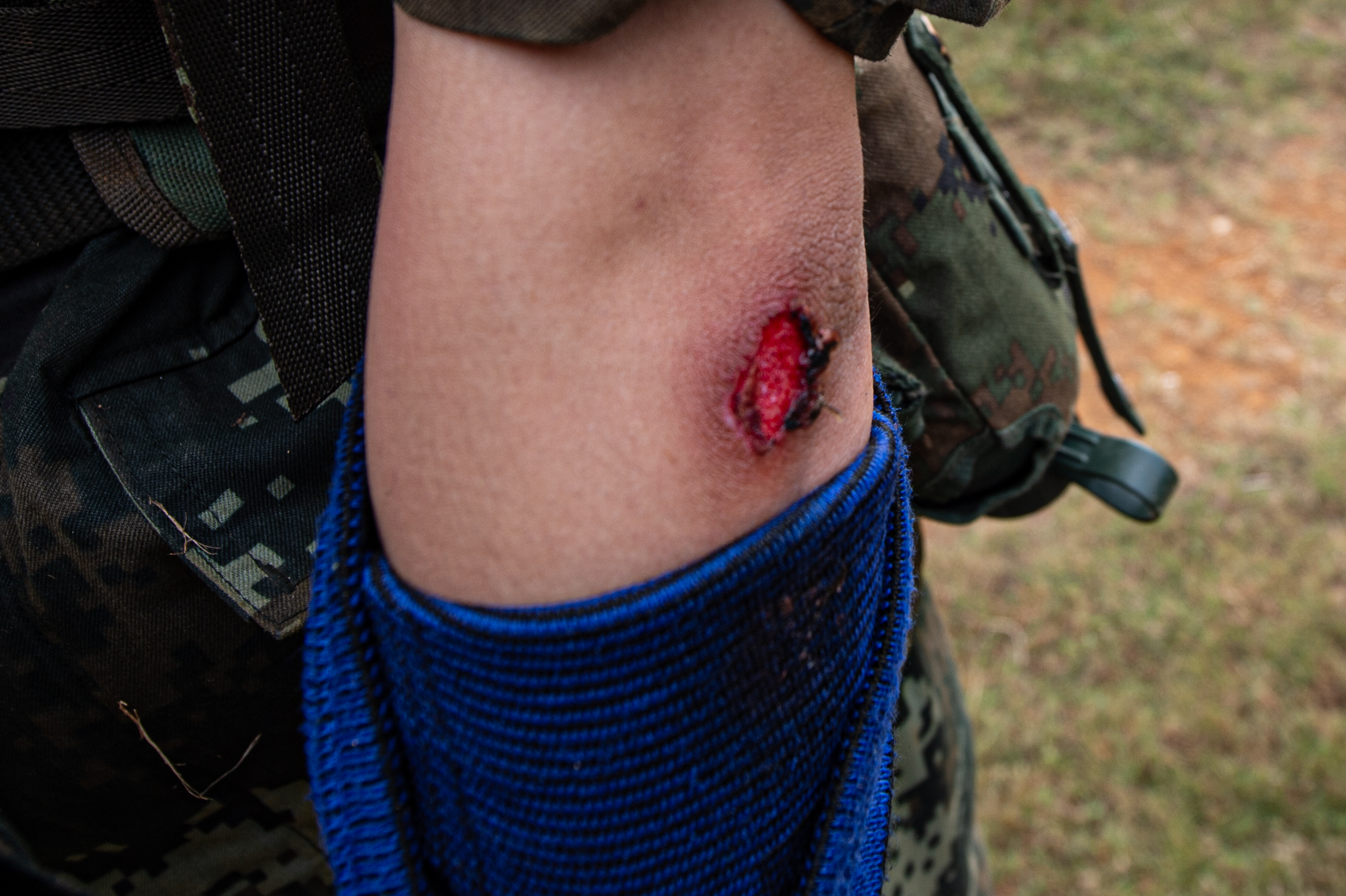2020年11月16日，一名武警新兵在戰術訓練時肘部留下的傷疤。