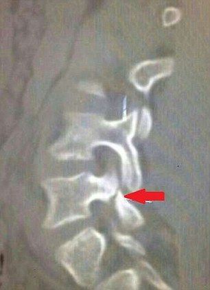 内马尔腰部的X光片