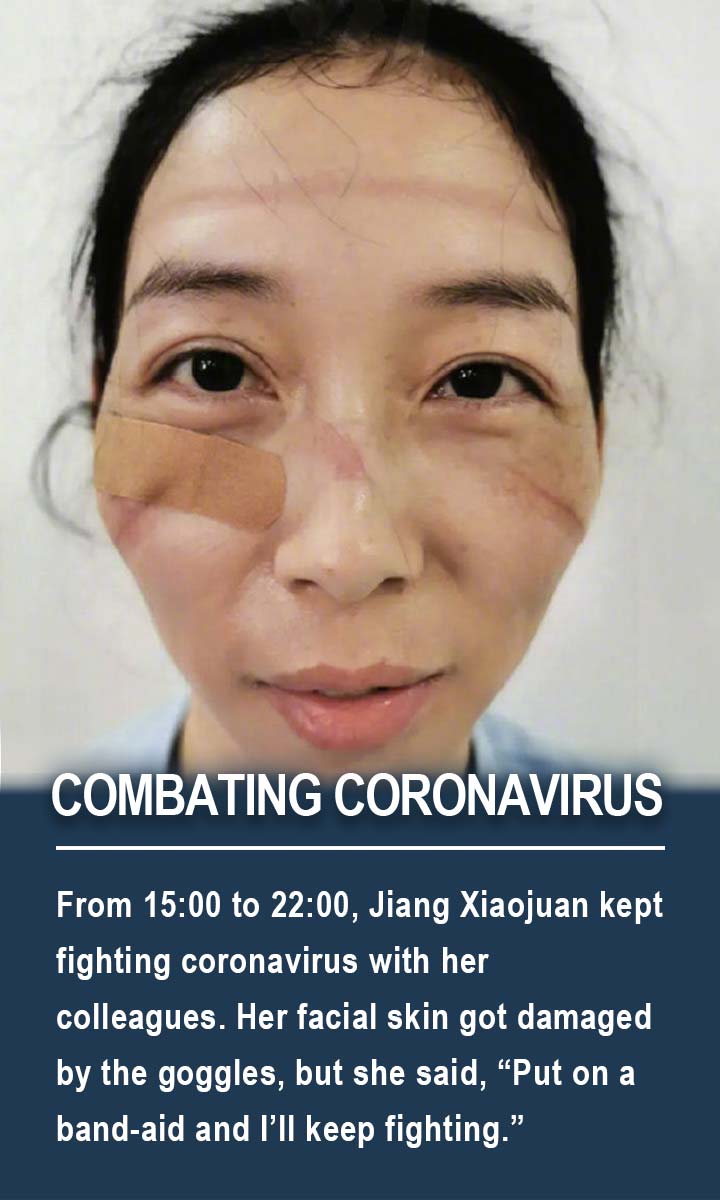 From 15:00 to 22:00, Jiang Xiaojuan kept fighting coronavirus with her colleagues. Her facial skin got damaged by the goggles, but she said, “Put on a band-aid and I’ll keep fighting.”