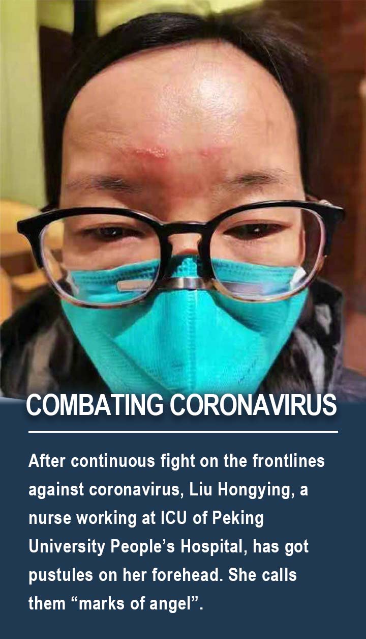 After continuous fight on the frontlines against coronavirus, Liu Hongying, a nurse working at ICU of Peking University People’s Hospital, has got pustules on her forehead. She calls them “marks of angel”.