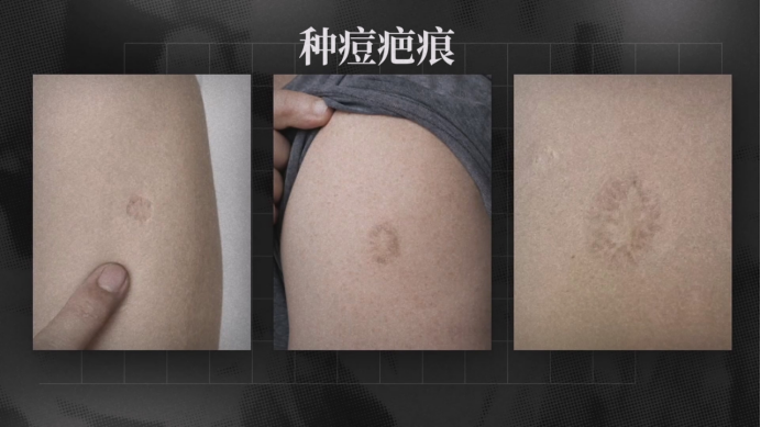 天花疫苗接种留下的疤痕