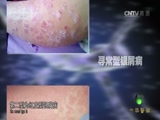 [中华医药]银屑病的类型CCTV节目官网CCTV4央视网(cctv.com)