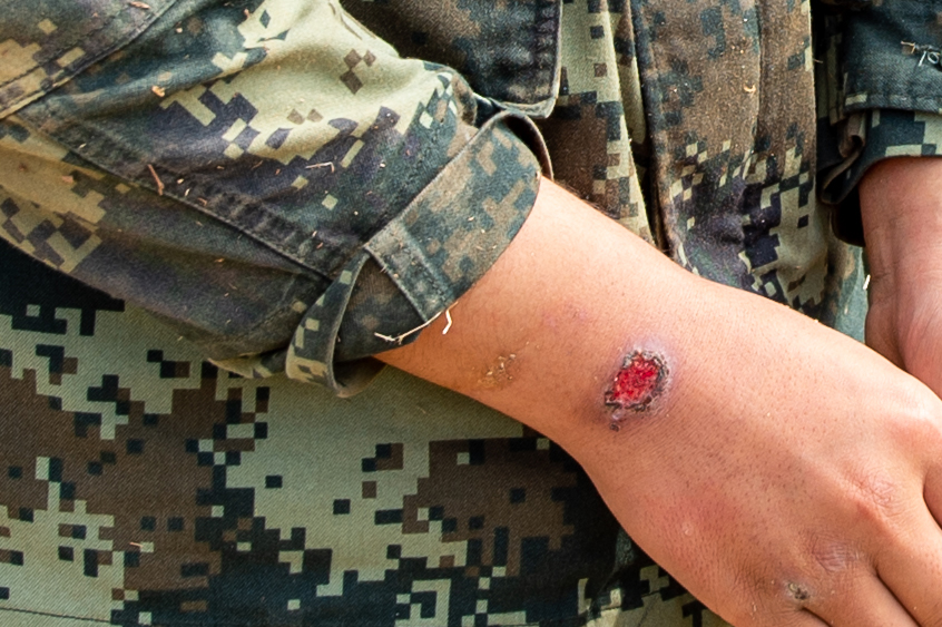 当兵不合格的疤痕图图片