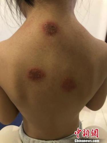 儿童三伏贴易引不良反应 民众吁医疗机构尽告知责任