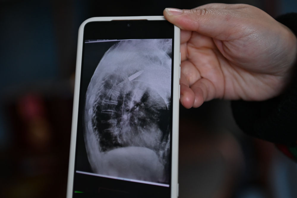 　　医院的放射线视觉指引图像显示，罗锦文老人右侧肩膀里有一颗长约3.5厘米的子弹（3月2日摄）。