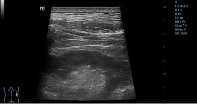 术后超声复查，示肾周及集合系统结构清晰，未见异常征象。